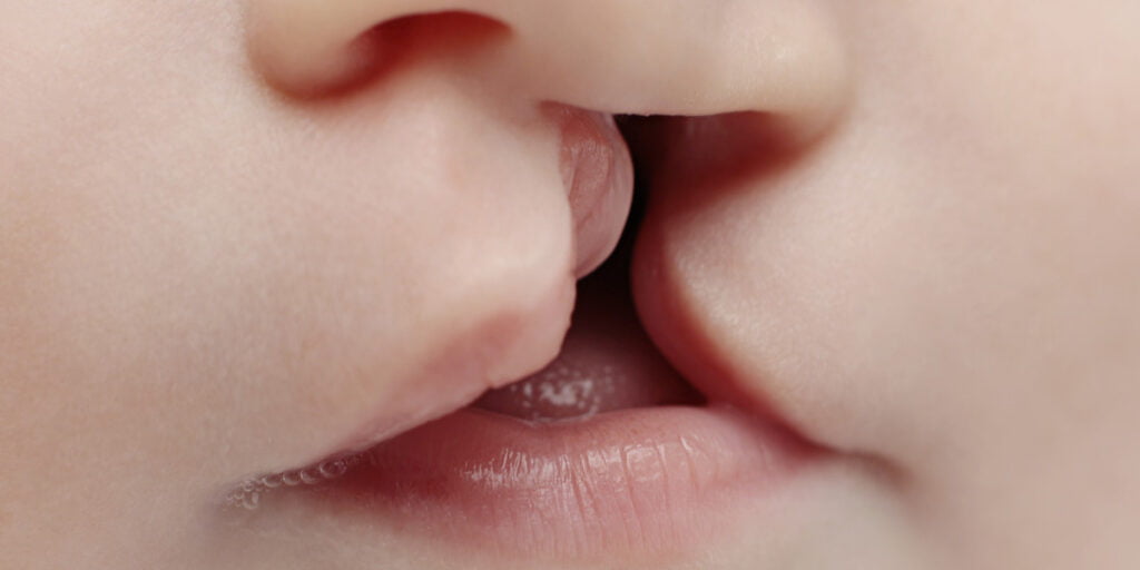 bibir sumbing pada bayi