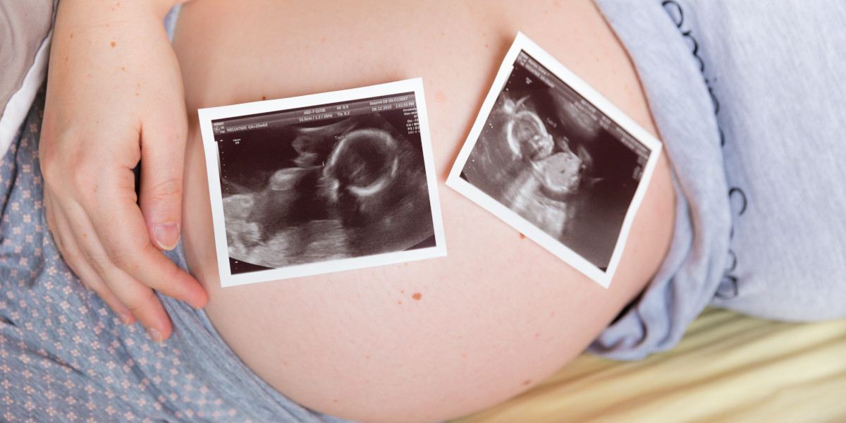 ciri-ciri hamil kembar