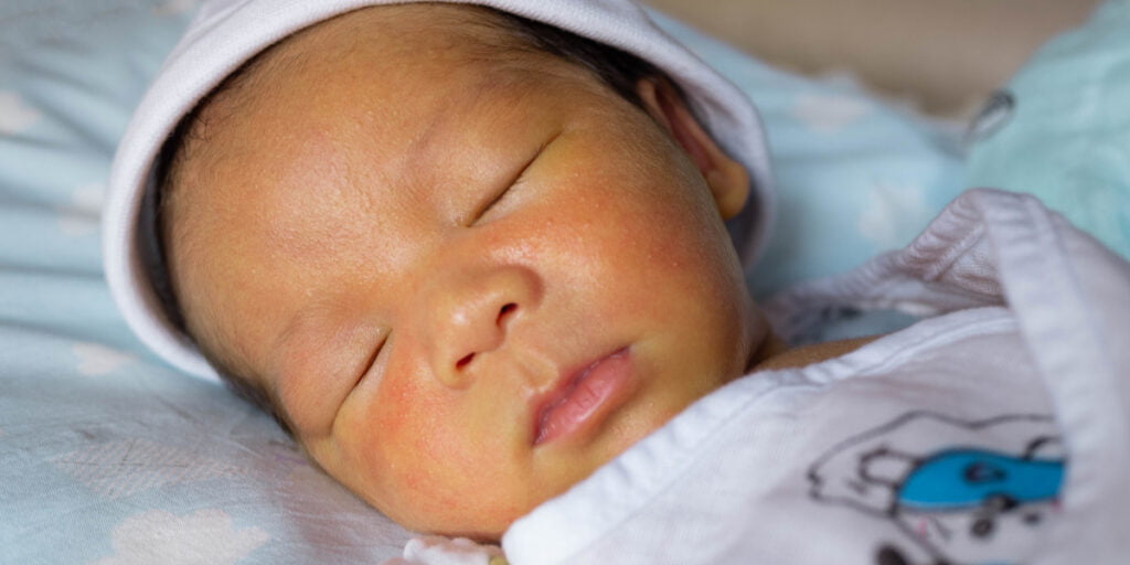 kuning pada bayi baru lahir