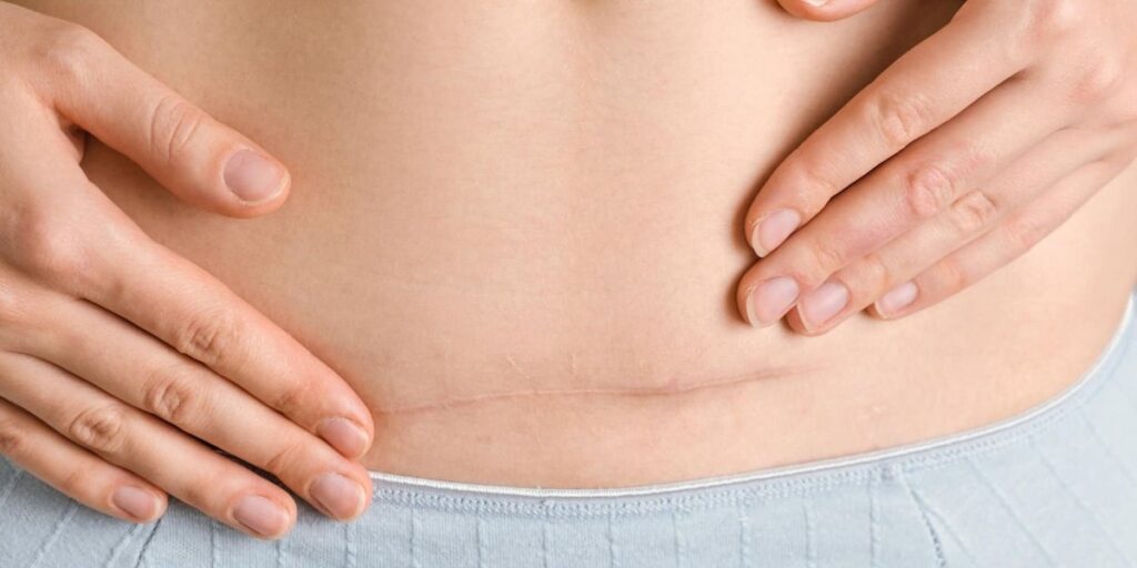 kapan luka operasi caesar sembuh