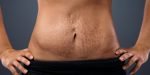 Capek dengan Stretch Mark? Ini Cara Menghilangkan Stretch Mark yang Ampuh!