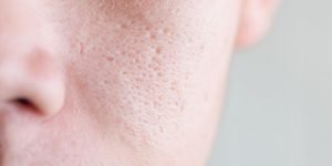 Pori Pori Wajah Besar