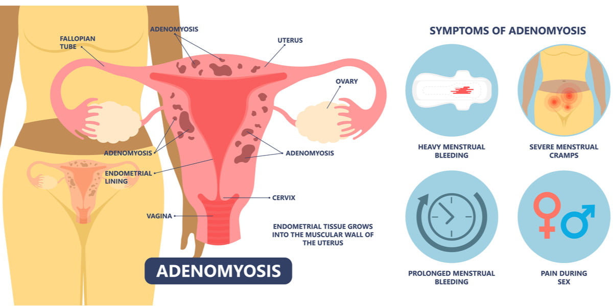 adenomiosis overview