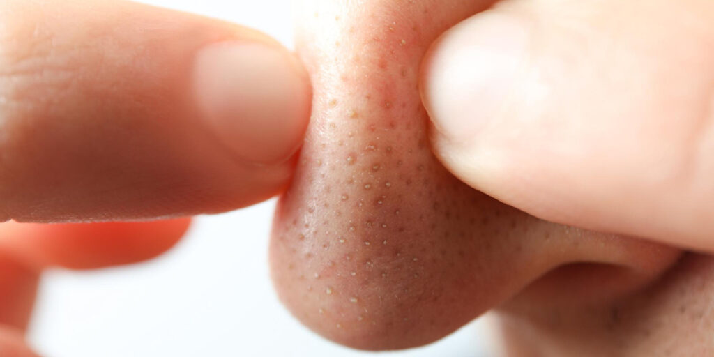 jenis jerawat inflamasi