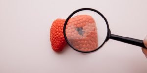 penyebab kanker tiroid