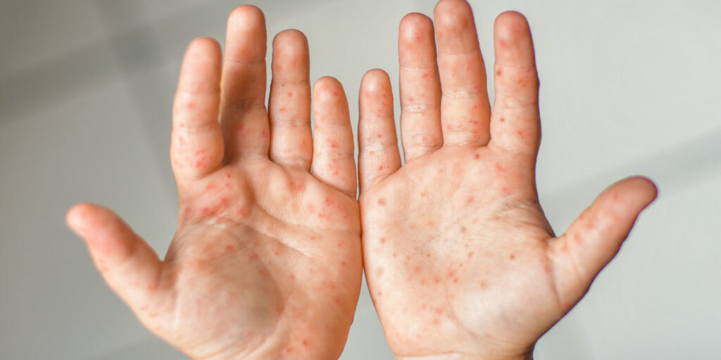 hand foot and mouth disease