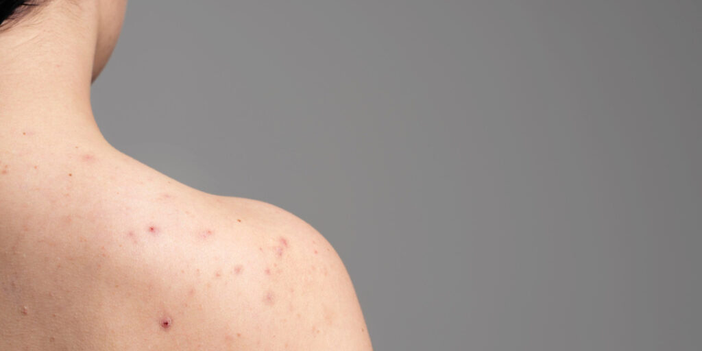 Penyebab jerawat di dada