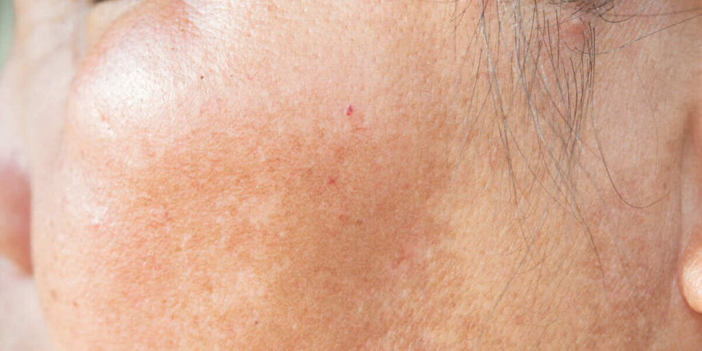 cara mengatasi bercak putih di wajah