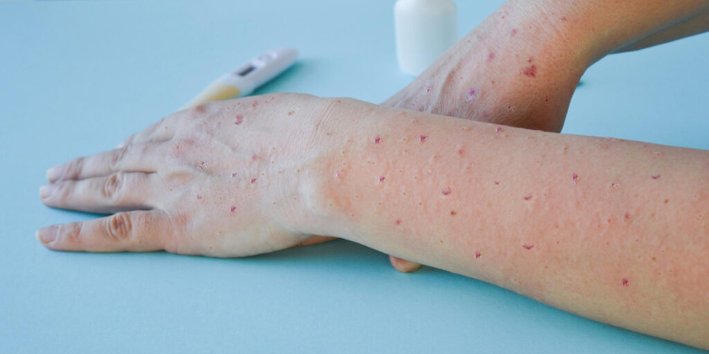 gejala herpes genital