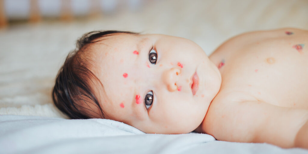 herpes pada bayi