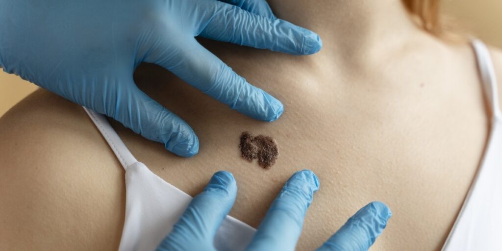 kanker kulit melanoma