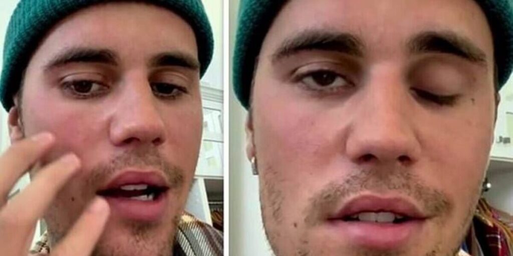 ramsay hunt syndrome justin bieber