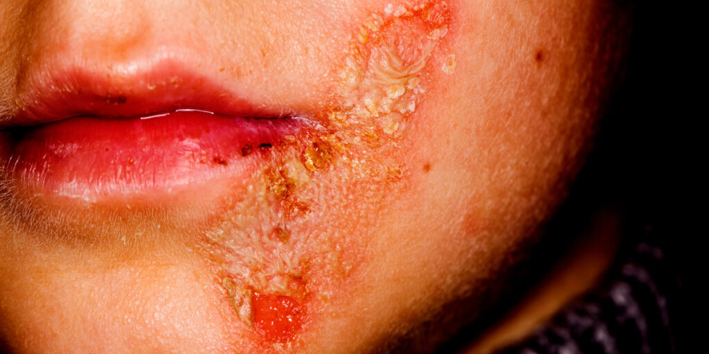 steven johnson syndrome