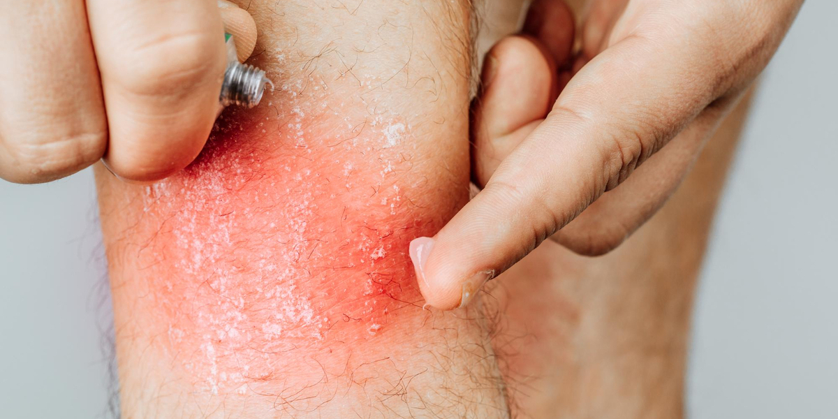 Cara mengatasi infeksi jamur kulit