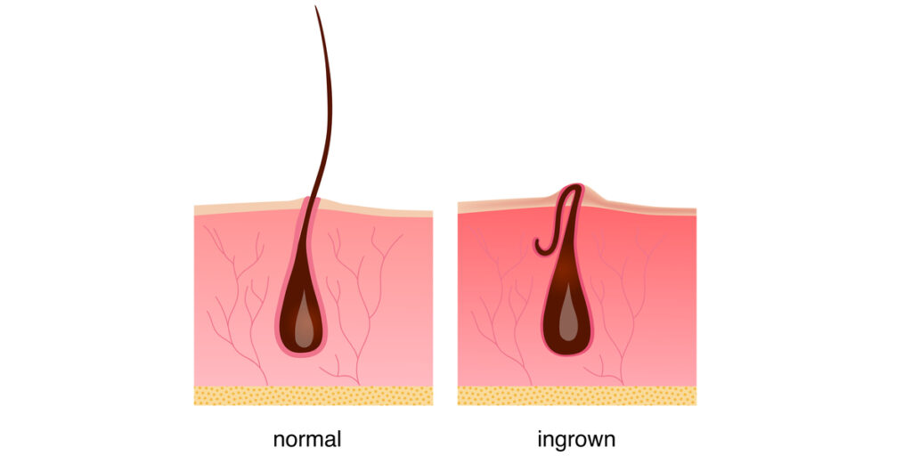 ingrown hair