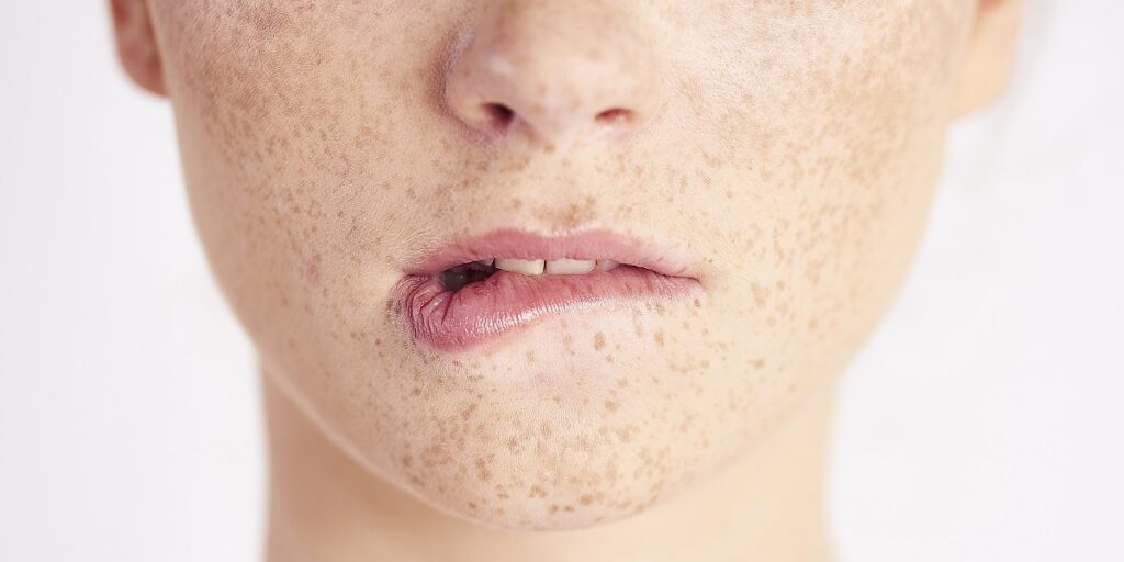 cara menghilangkan freckles