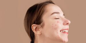 ciri-ciri jerawat hormon