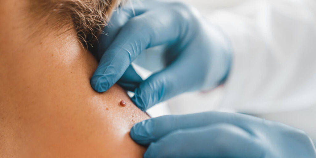 cara menghilangkan skin tag