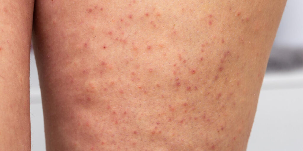ingrown hair adalah
