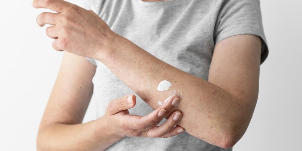 dermatitis atopik adalah