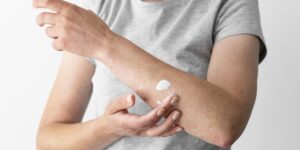 dermatitis atopik adalah