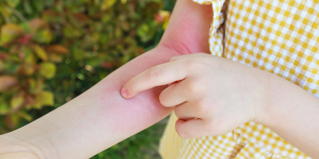 Penyebab Bintik Merah Pada Kulit Bayi Bisa Jadi Ruam Popok