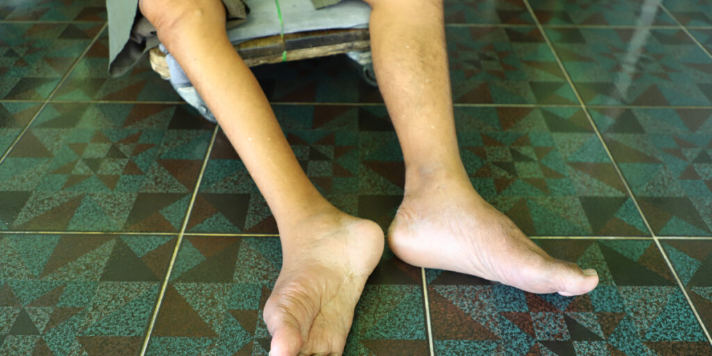 penyebab penyakit polio adalah
