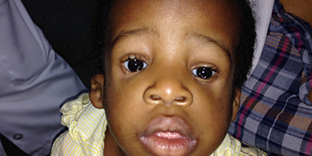 Treacher Collins syndrome