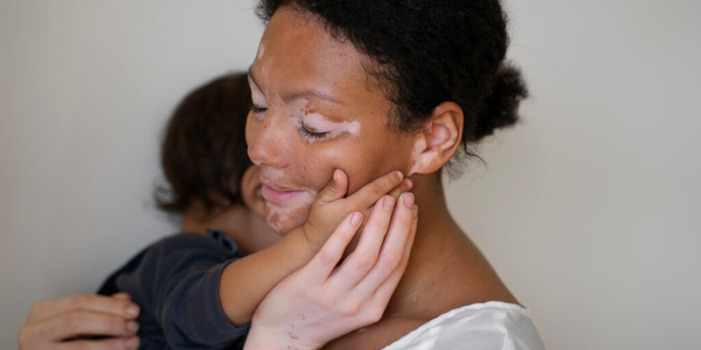 vitiligo adalah