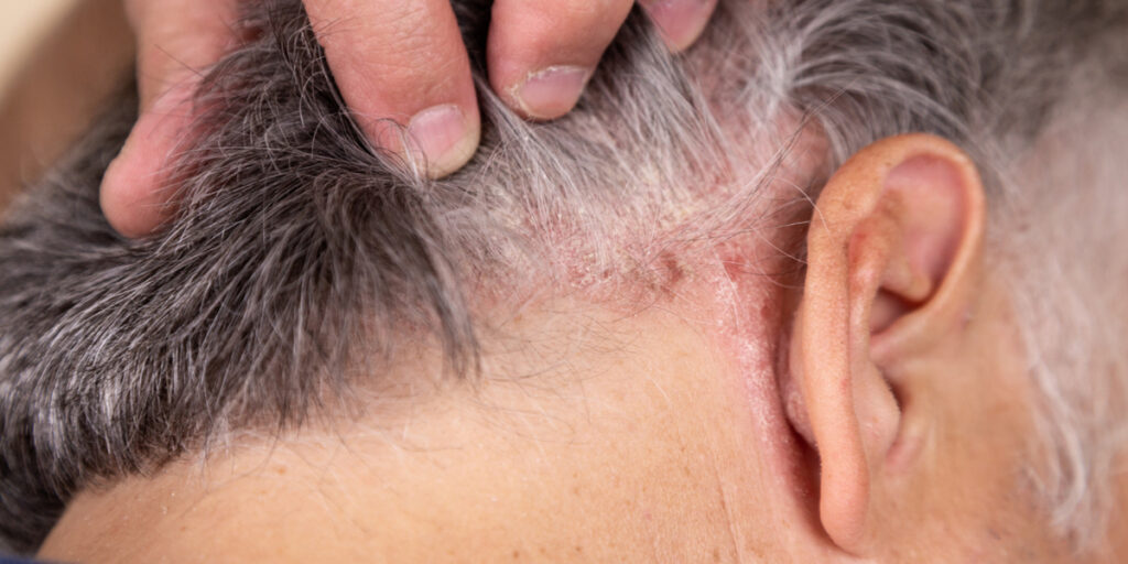 psoriasis kulit kepala