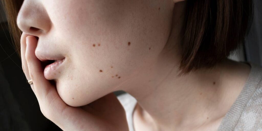 cara menghilangkan tahi lalat di wajah