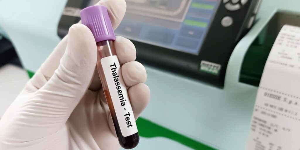 diagnosis thalasemia minor