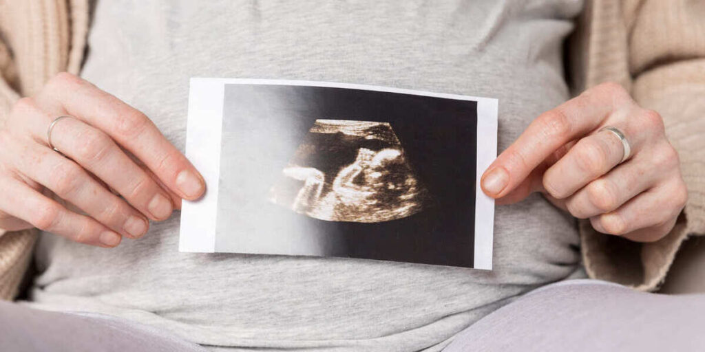 penyebab bayi sungsang