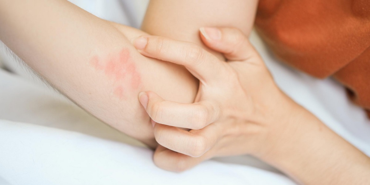 penyebab dan cara mengatasi biduran setelah melahirkan