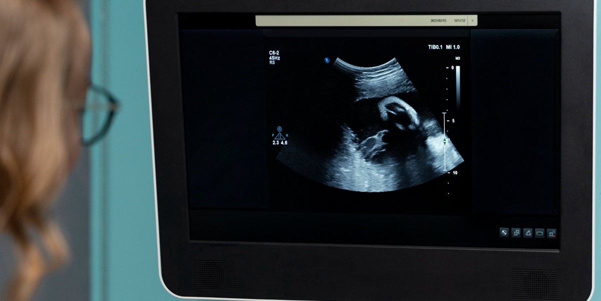 cara deteksi fetus in fetu