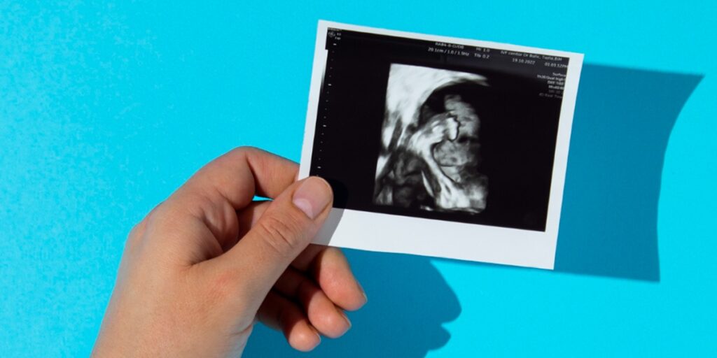 mengenal fetus in fetu