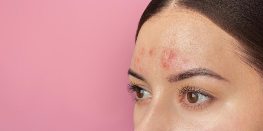 kulit merah dan panas