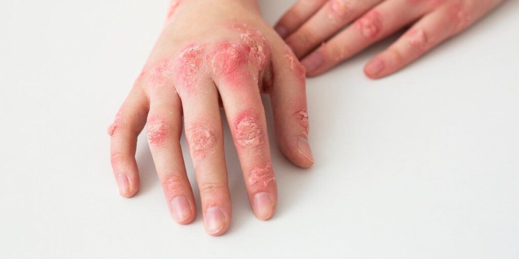 penularan virus monkeypox