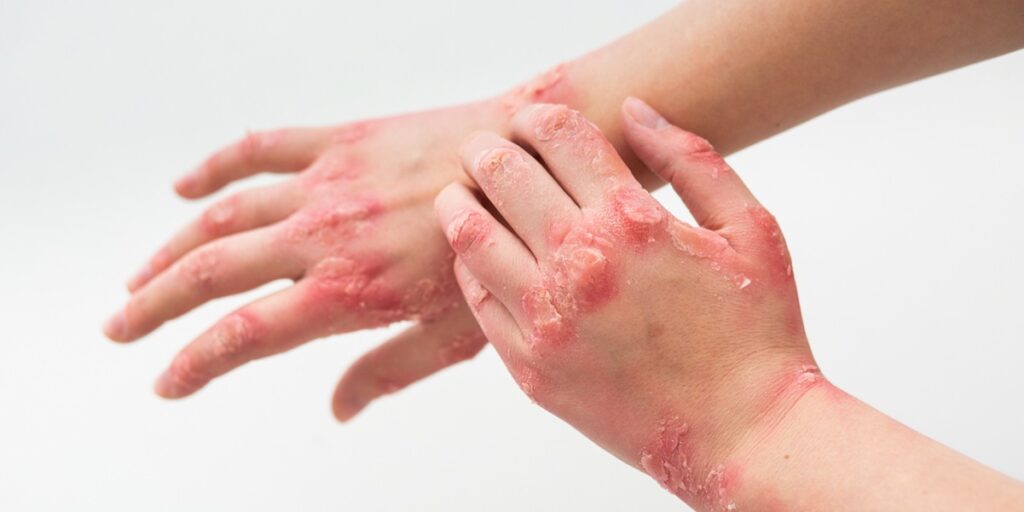 world psoriasis day 29 oktober